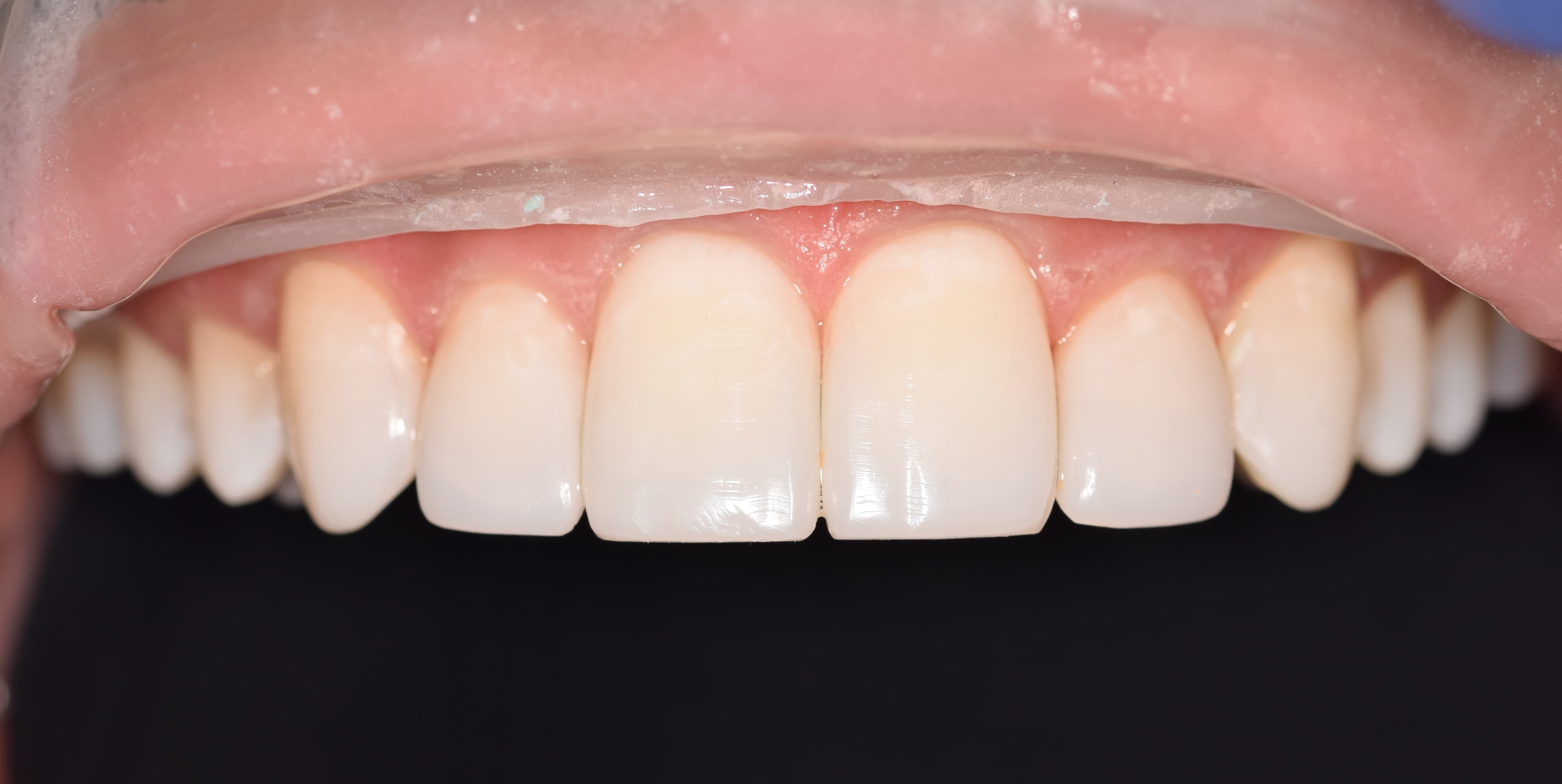 Composite Bonding after