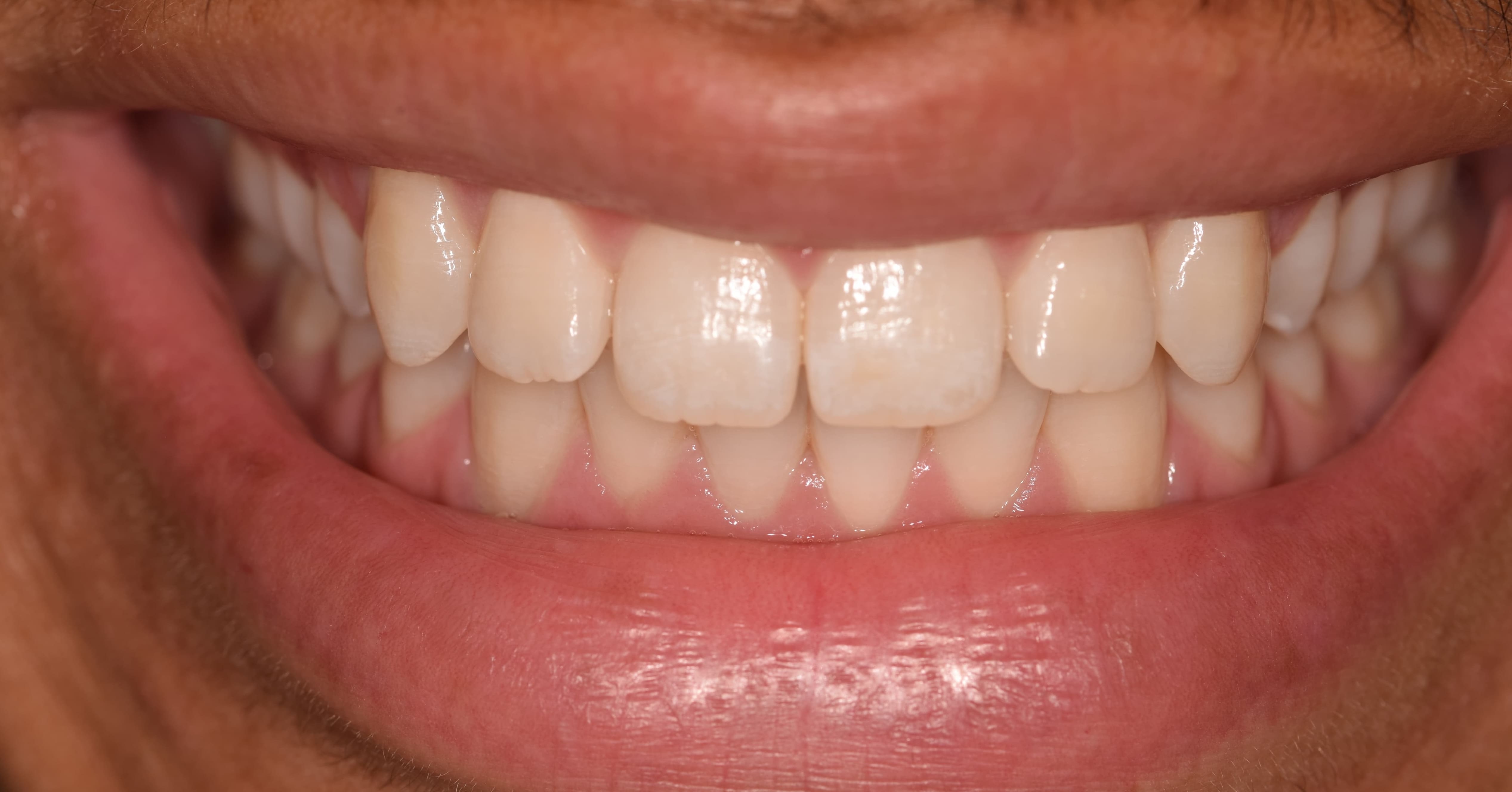 Porcelain Veneers on 4 before