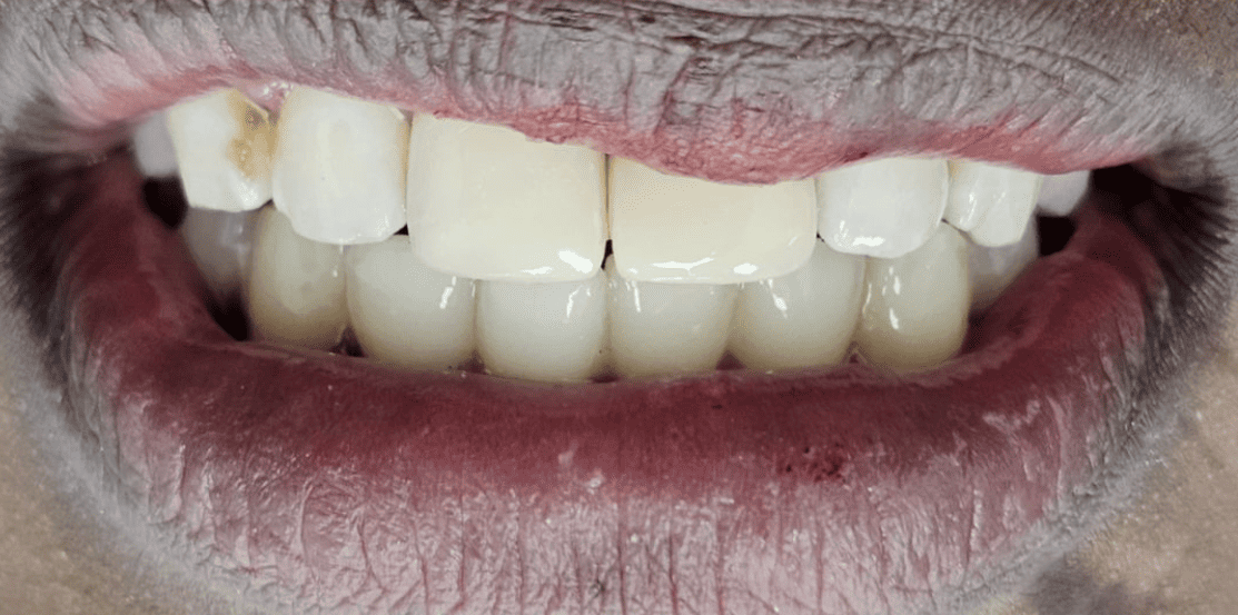 Emergency Tooth Repair after