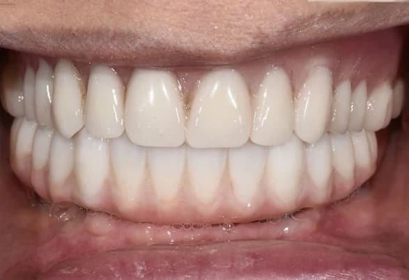 After multiple implants