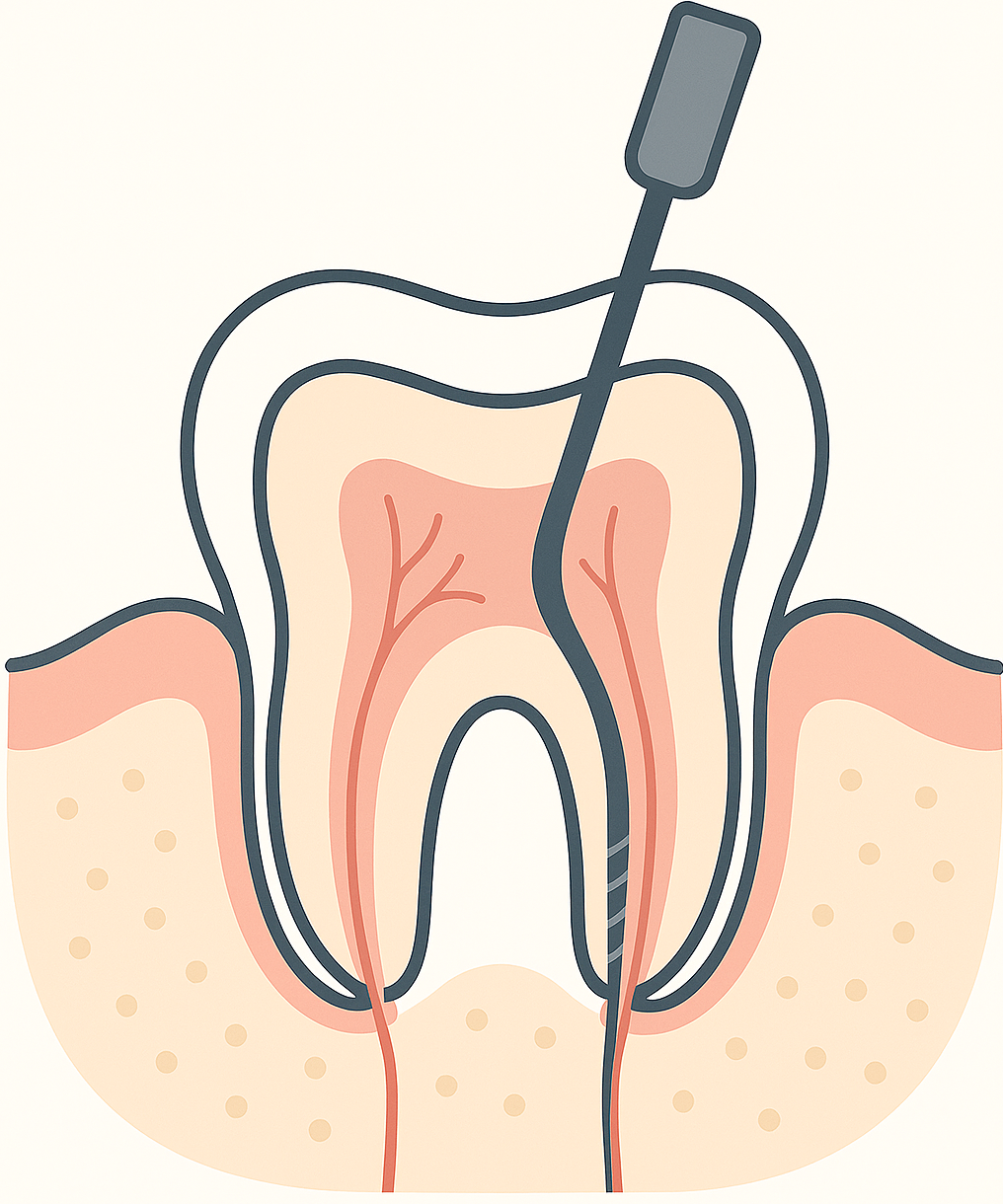 root canal treatment Birmingham